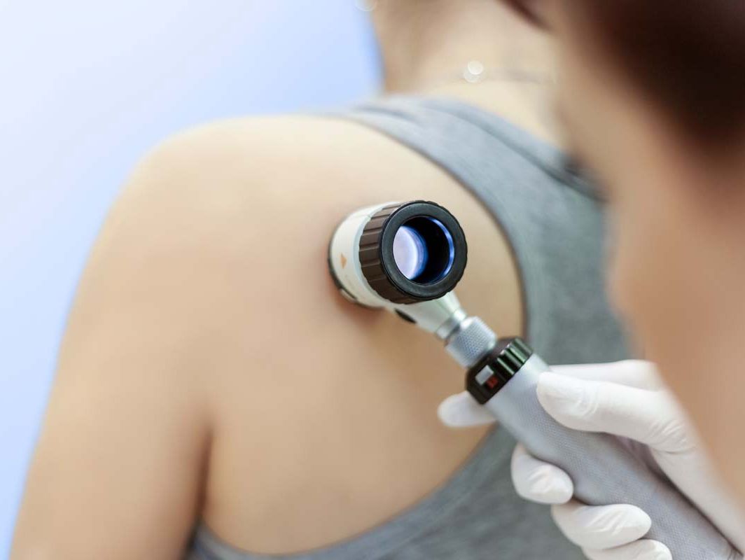 Hautkrebsvorsorge und Muttermalkontrolle